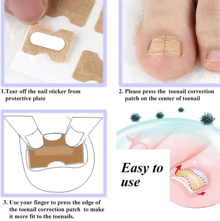 Toenail Corrector Patch (30 Pack)