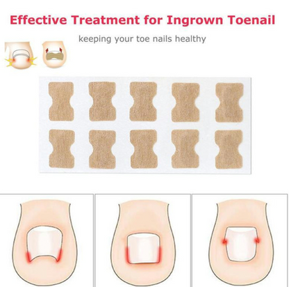 Toenail Corrector Patch (30 Pack)